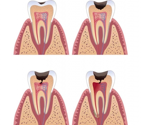 Trattamenti endodontici